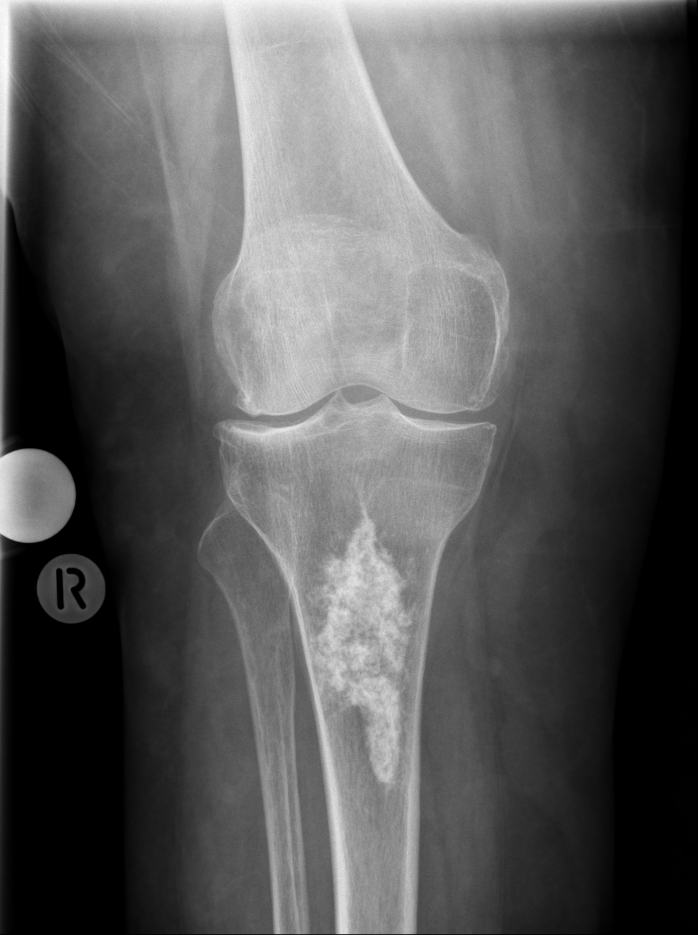 Tibia And Fibula Anatomy