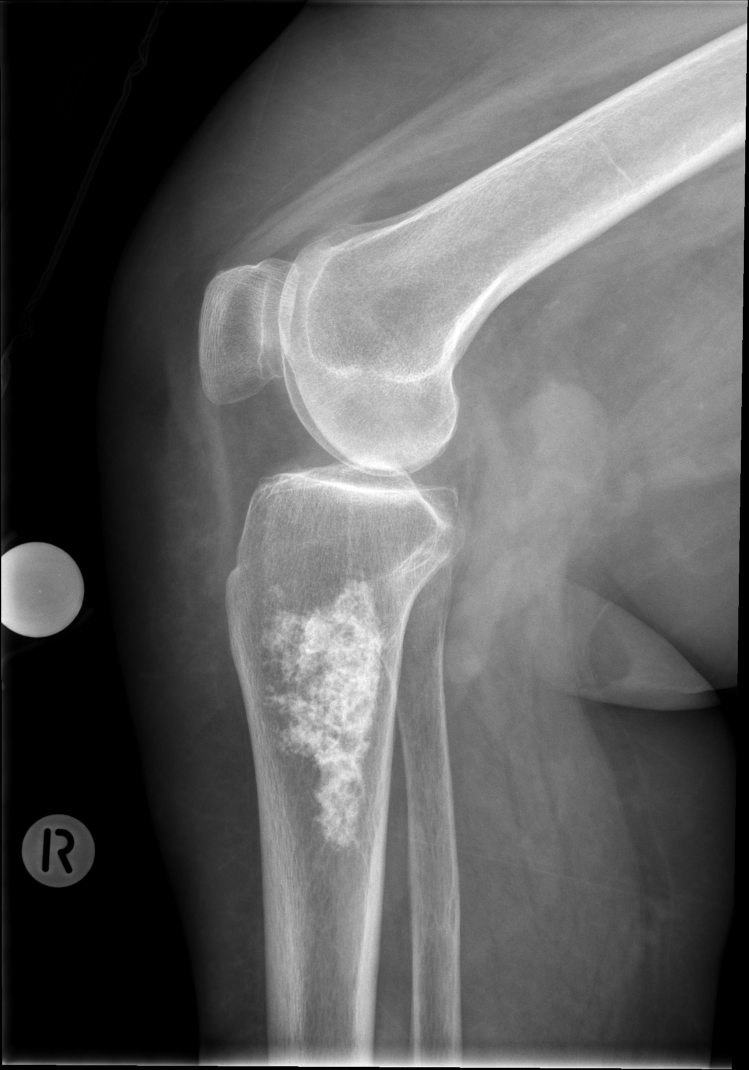 Tibial enchondroma | Image | Radiopaedia.org