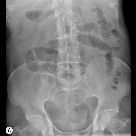 Xray Scans A Supine View B Crosstable Lateral View