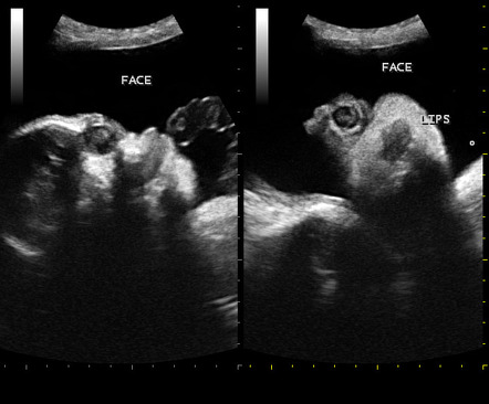 Cyclopia | Radiology Case | Radiopaedia.org