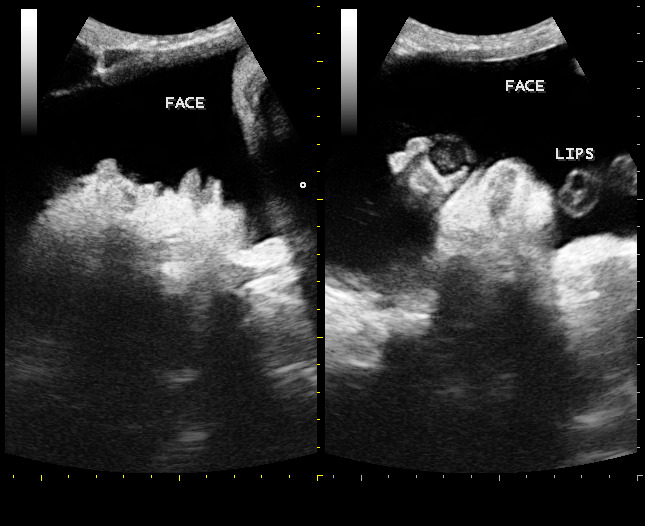 Cyclopia | Image | Radiopaedia.org