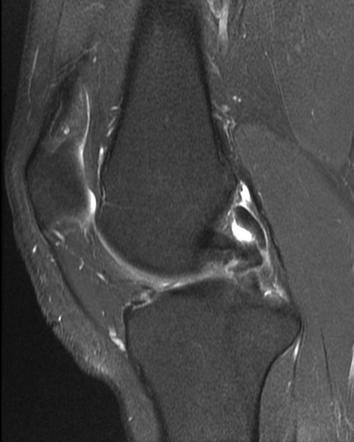 Double PCL sign | Radiology Reference Article | Radiopaedia.org