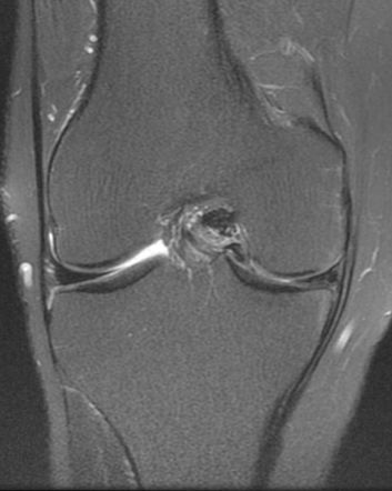 Double Pcl Sign Of Meniscal Bucket Handle Tear 