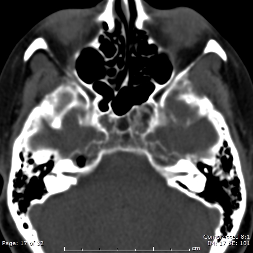 Arrested pneumatization of the sphenoid | Image | Radiopaedia.org