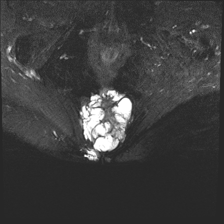 Sacrococcygeal chordoma | Image | Radiopaedia.org