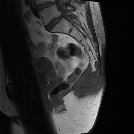 Sacrococcygeal Chordoma | Image | Radiopaedia.org