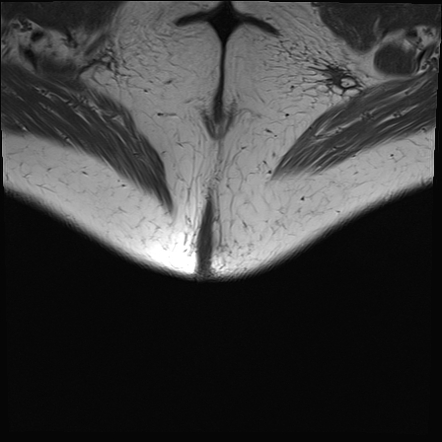 Sacrococcygeal chordoma | Image | Radiopaedia.org