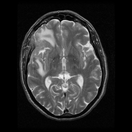 Papillary meningioma | Radiology Reference Article | Radiopaedia.org