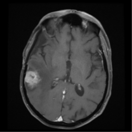 Anaplastic meningioma with recurrence | Image | Radiopaedia.org