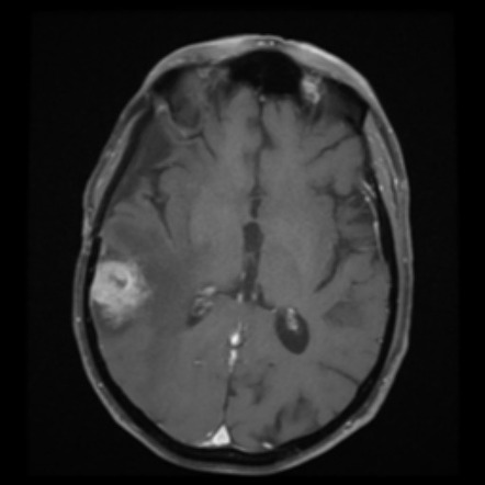 Anaplastic meningioma with recurrence | Image | Radiopaedia.org