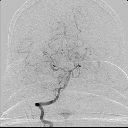 Convexity subarachnoid hemorrhage: reversible cerebral vasoconstriction ...