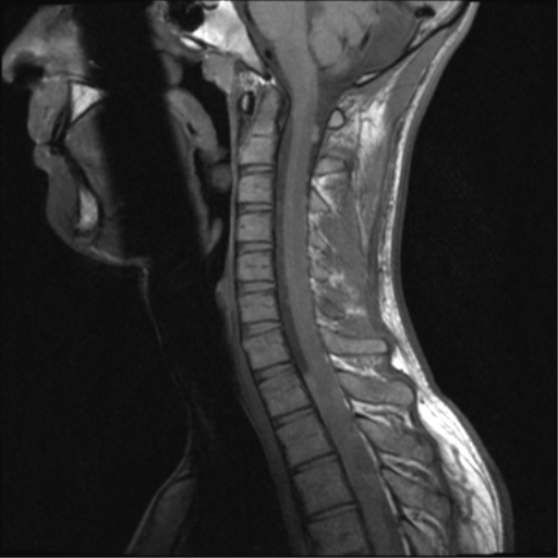 Spinal astrocytoma | Image | Radiopaedia.org