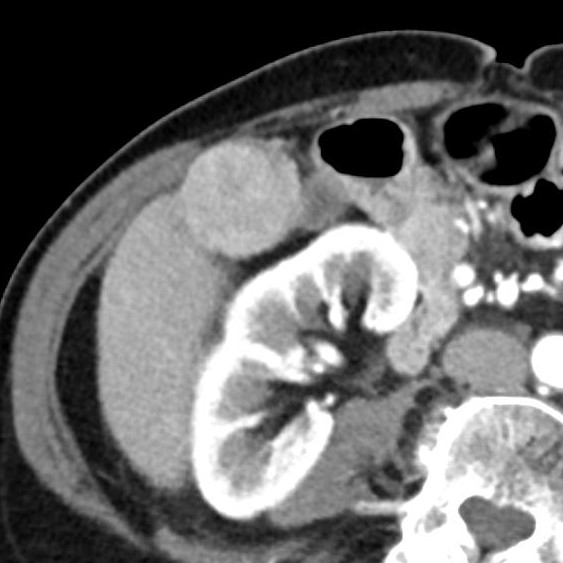 Hepatocellular Carcinoma Exophytic Image