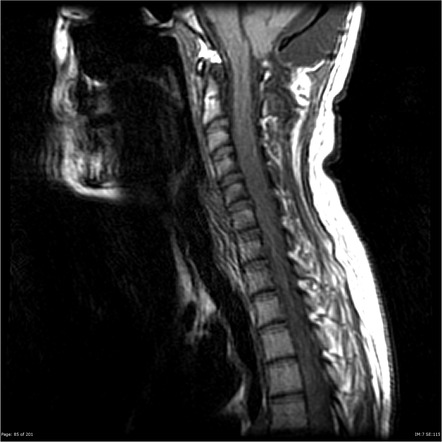 Extensive leptomeningeal metastases | Radiology Case | Radiopaedia.org