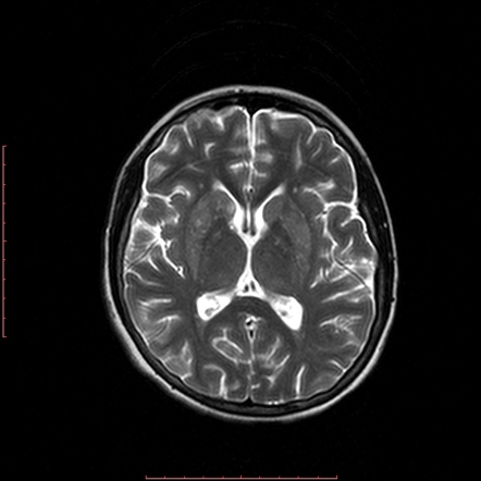 Viewing playlist: MRI basal ganglia | Radiopaedia.org