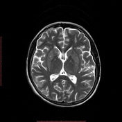 Leigh syndrome | Radiology Reference Article | Radiopaedia.org