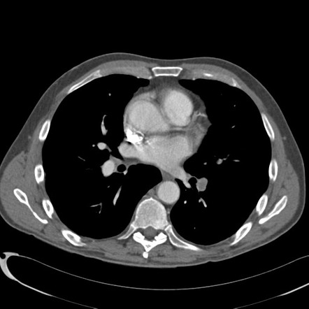 Pulmonary embolism and infarct | Radiology Case | Radiopaedia.org