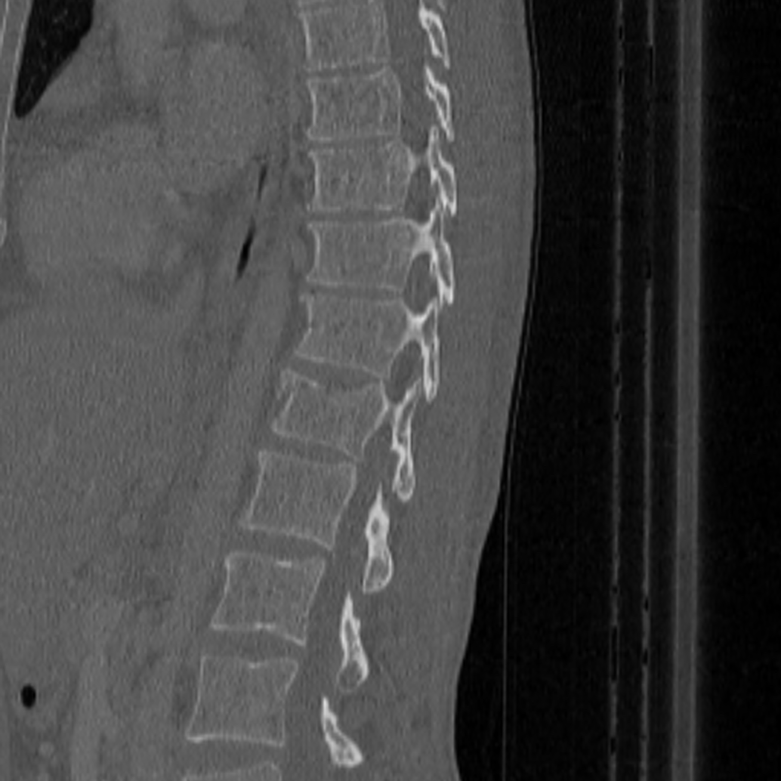 Bulging of paraspinal line in traumatic thoracal spinal compression ...