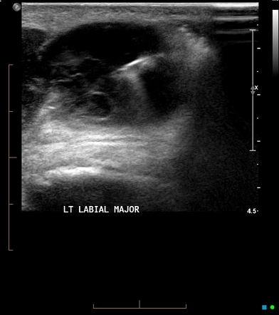 Vulval hematoma | Image | Radiopaedia.org