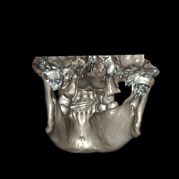 Cemento-ossifying fibroma of mandible | Image | Radiopaedia.org