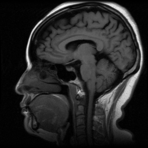 Left petroclival meningioma | Image | Radiopaedia.org