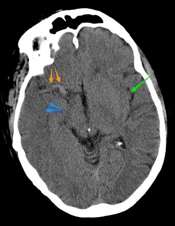 Paradoxical Subfalcine Brain Herniation Image Radiopaedia Org