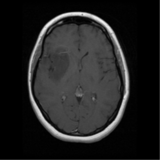 Oligoastrocytoma NOS | Image | Radiopaedia.org