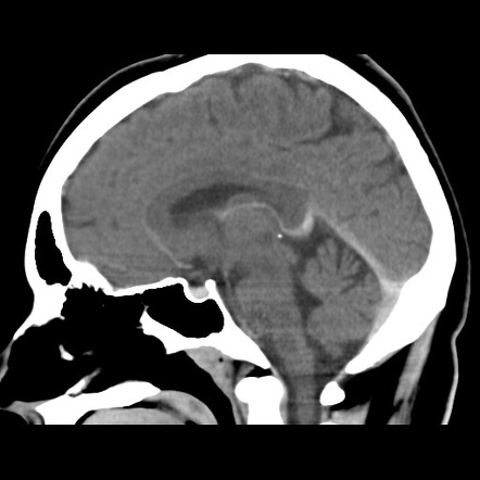 Oligoastrocytoma NOS | Image | Radiopaedia.org