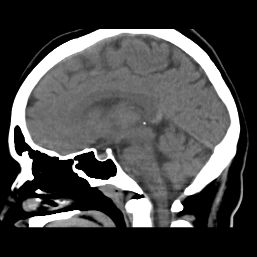 Oligoastrocytoma NOS | Image | Radiopaedia.org