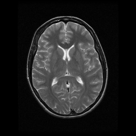 Fibrous dysplasia of the skull | Image | Radiopaedia.org