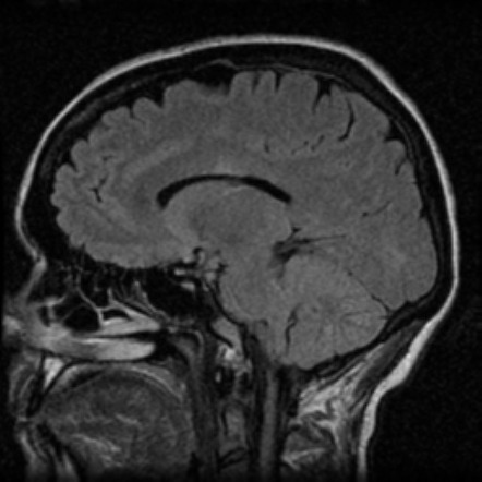 Neuromyelitis optica | Image | Radiopaedia.org