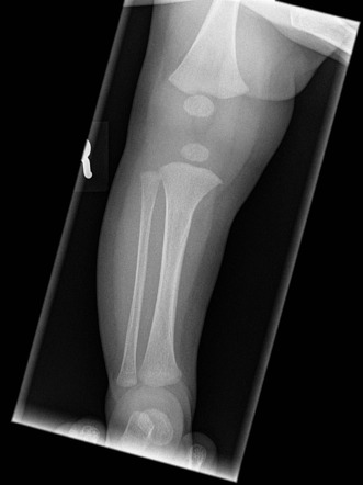 Non-accidental injury | Image | Radiopaedia.org