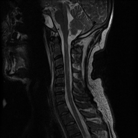 Pneumococcal meningitis with myelitis | Radiology Case | Radiopaedia.org