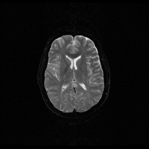 Pneumococcal meningitis with myelitis | Image | Radiopaedia.org