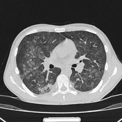 Diffuse ground-glass nodules | Radiology Reference Article ...