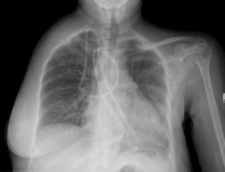 Amputation (generic) | Radiology Reference Article | Radiopaedia.org