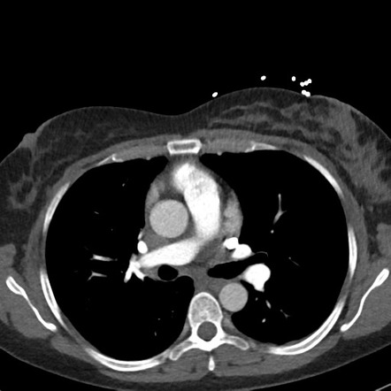 Superior vena caval duplication | Radiology Reference Article ...