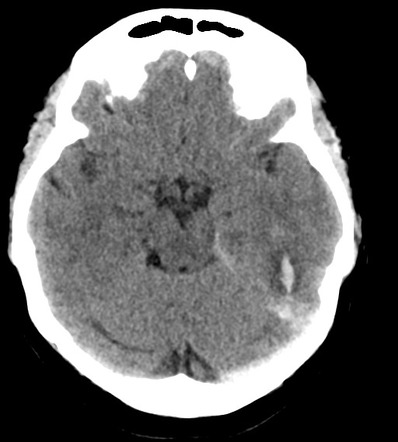 Dural Venous Sinus Thrombosis Radiology Reference Article