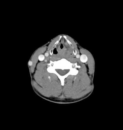 Laryngeal haematoma | Radiology Case | Radiopaedia.org