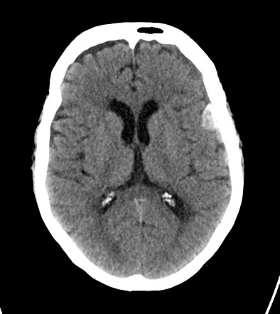 Isodense subdural haemorrhage and adjacent meningioma | Radiology Case ...