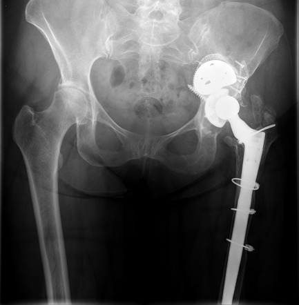 Dual total hip joint replacement acetabular cups | Radiology Case ...