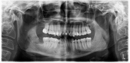 Odontogenic right submandibular abscess | Image | Radiopaedia.org