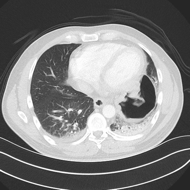 Diaphragmatic rupture | Radiology Reference Article | Radiopaedia.org