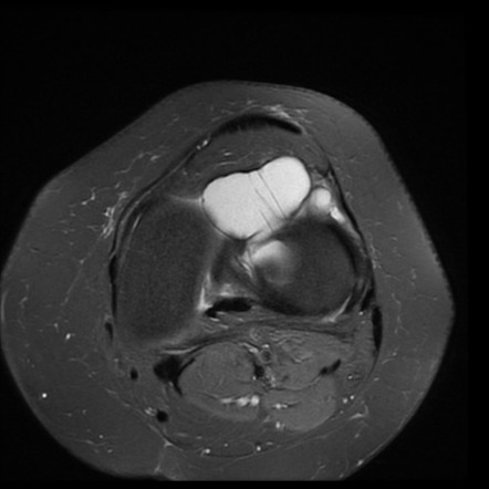 Meniscal cyst | Radiology Reference Article | Radiopaedia.org