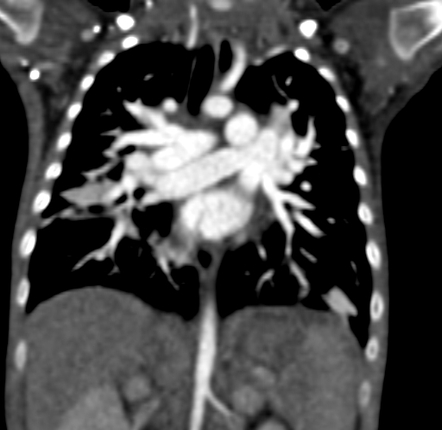 Supra-cardiac total anomalous pulmonary venous return (TAPVR ...