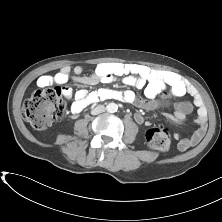 Colovesical fistula due to sigmoid colitis | Radiology Case ...