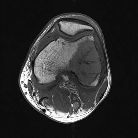 Lytic bone metastases | Radiology Reference Article | Radiopaedia.org