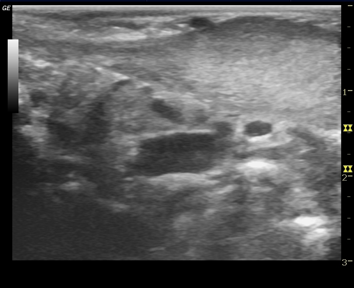 Torticollis Ultrasound