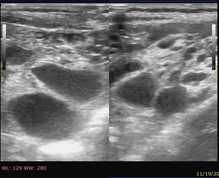 Peritoneal hydatidosis | Radiology Reference Article | Radiopaedia.org