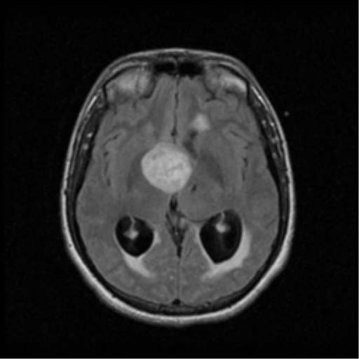 Pilocytic astrocytoma of the third ventricle | Image | Radiopaedia.org